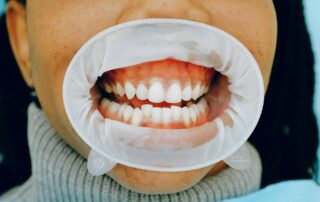 Could Statins Help Treat Gum Disease?