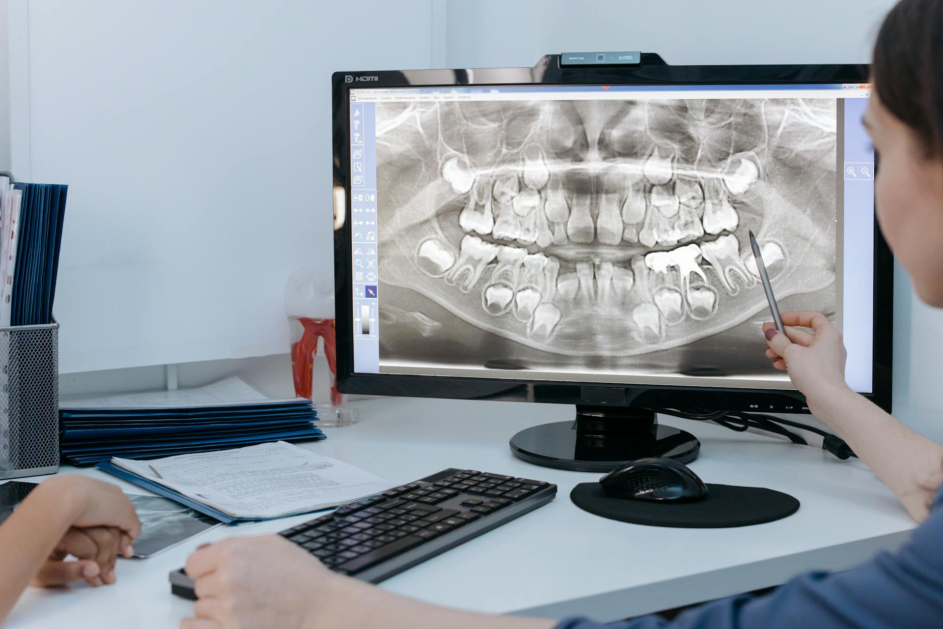 Direct Composite or Zirconia: Which Is Better for Replacing a Single Missing Anterior Tooth?